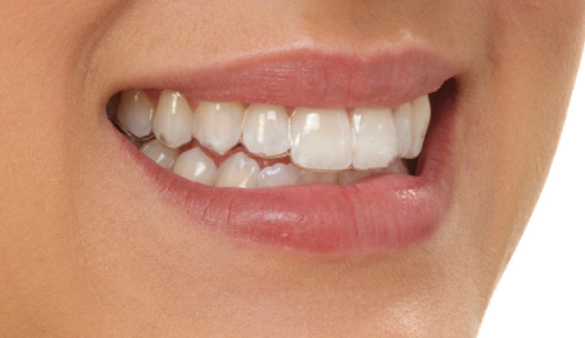 Clearguide Aligner Quality